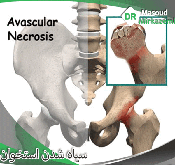 عکس سیاه شدن استخوان لگن