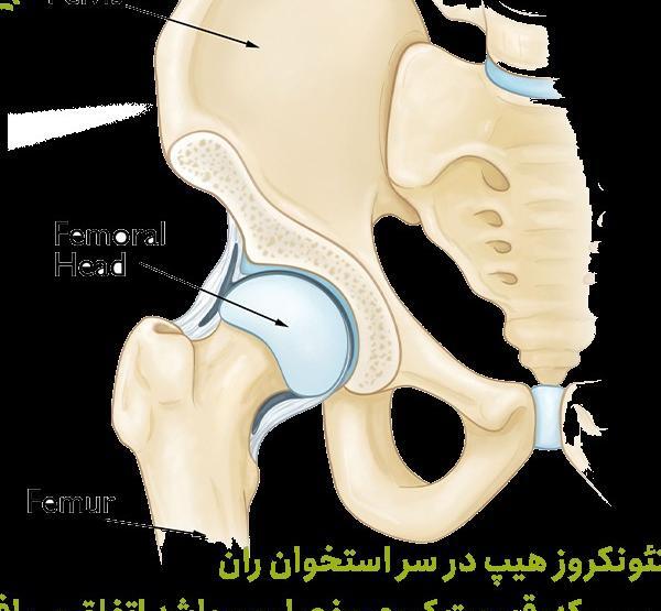 عکس سیاه شدن استخوان لگن