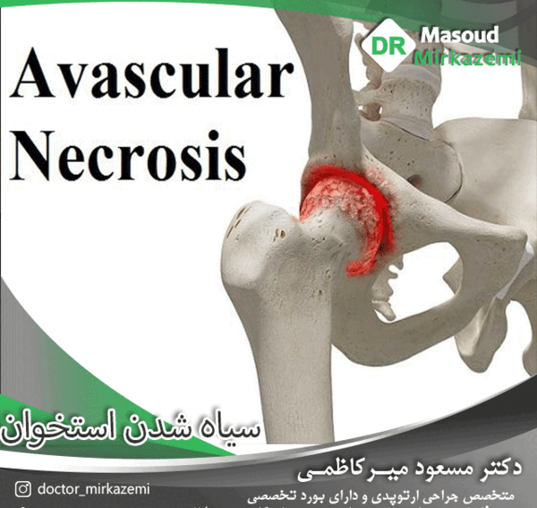 عکس سیاه شدن استخوان لگن