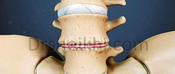 عکس سیاه شدن مهره کمر