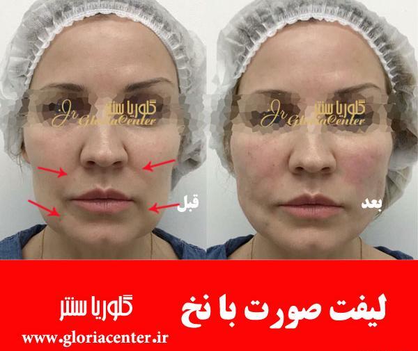 عکسهای لیفت صورت با نخ