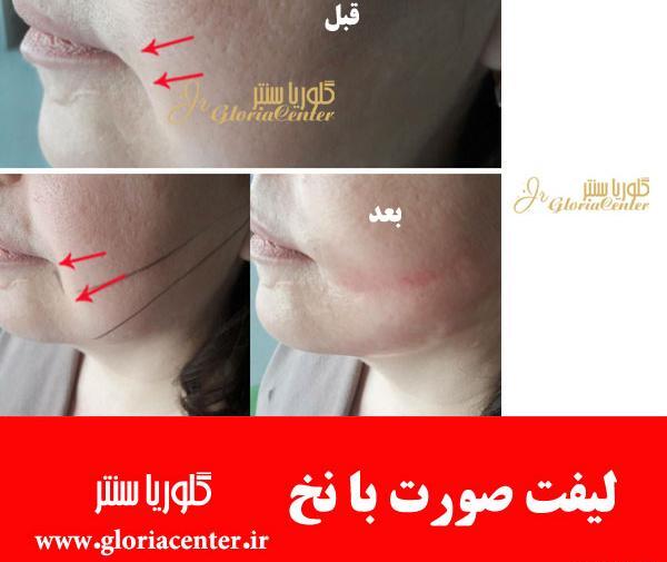 عکسهای لیفت صورت با نخ