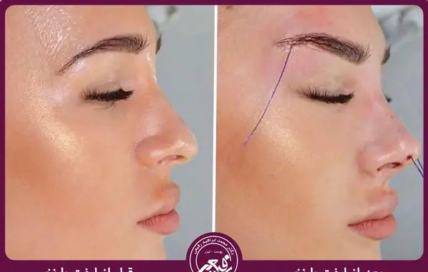 عکسهای لیفت صورت با نخ