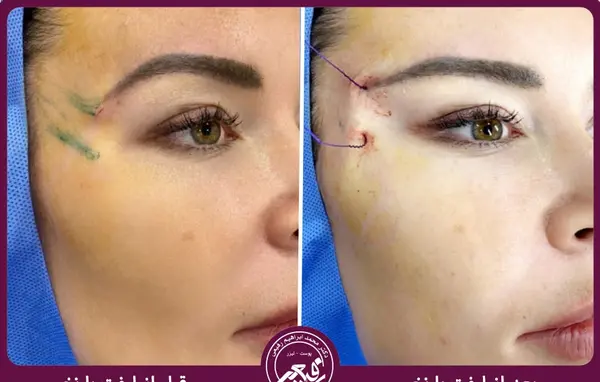 عکسهای لیفت صورت با نخ