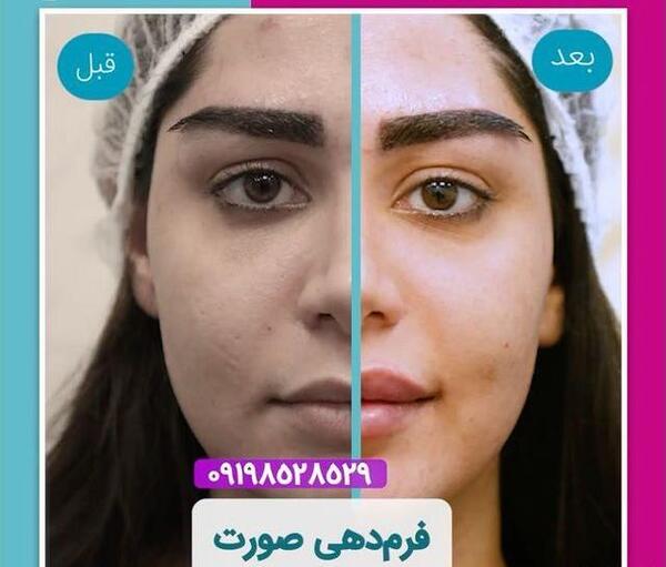 عکسهای لیفت صورت با نخ