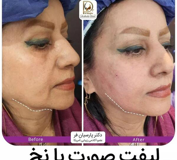 عکسهای لیفت صورت با نخ