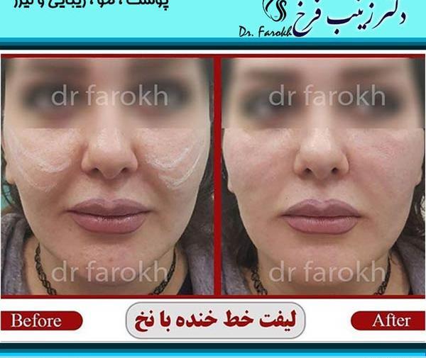 عکسهای لیفت صورت با نخ