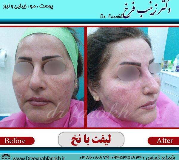 عکسهای لیفت صورت با نخ