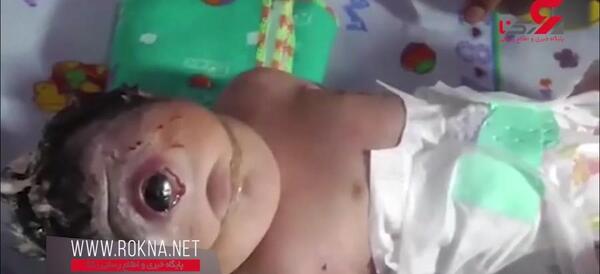عکس نوزاد عجیب الخلقه در اندونزی