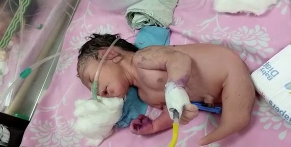 عکس نوزاد عجیب الخلقه در اندونزی