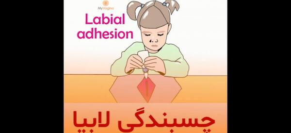 عکس چسبندگی لابیا نوزاد دختر