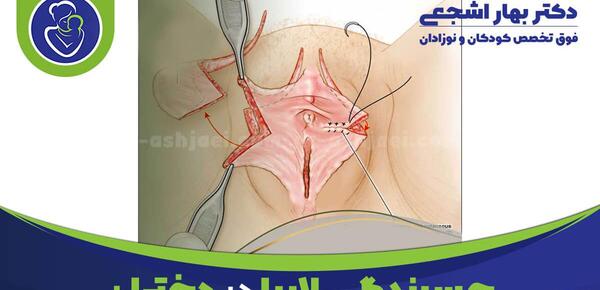 عکس چسبندگی لابیا نوزاد دختر