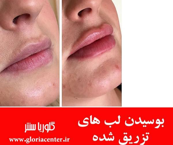 عکس سوتی کبودی نی نی سایت