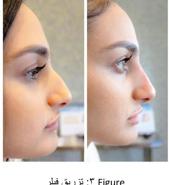 عکس فیلر بینی