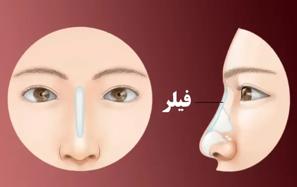 عکس فیلر بینی