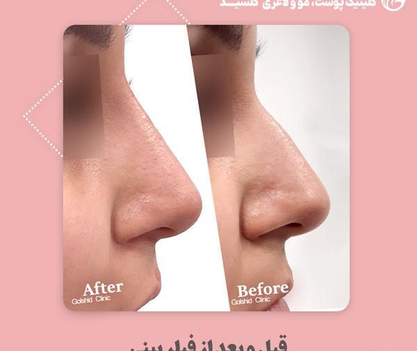 عکس فیلر بینی