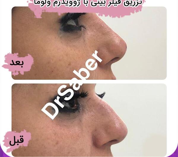 عکس فیلر بینی