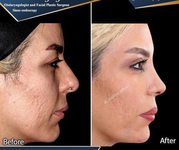 عکس فیلر بینی