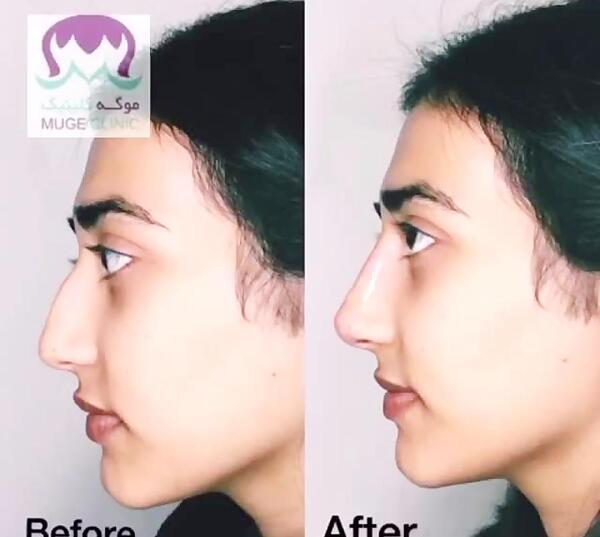عکس فیلر بینی