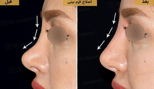 عکس فیلر بینی