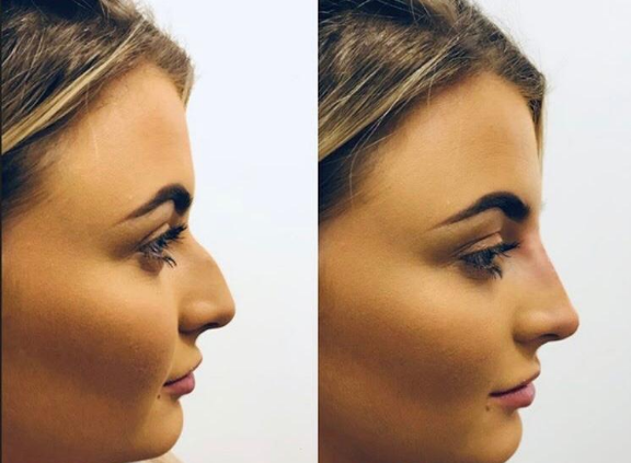 عکس فیلر بینی