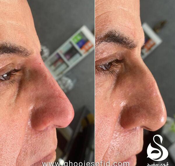 عکس فیلر بینی