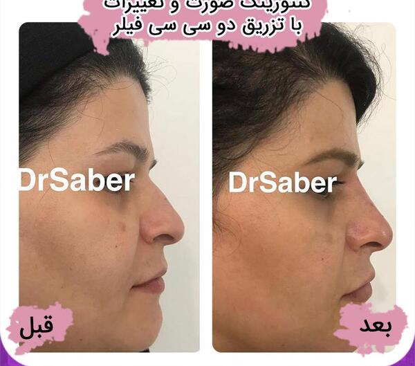 عکس فیلر بینی