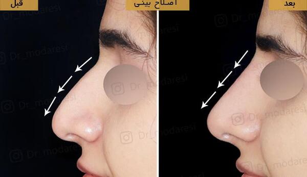 عکس فیلر بینی