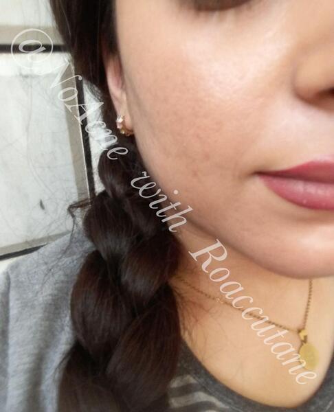 عکس جوش صورتم نی نی سایت