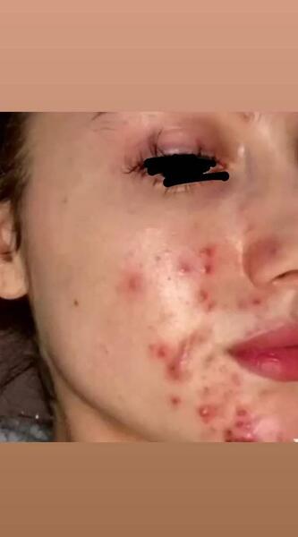 عکس جوش صورتم نی نی سایت
