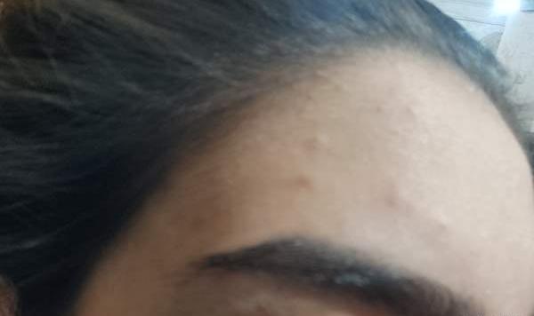 عکس جوش صورتم نی نی سایت