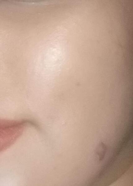 عکس جوش صورتم نی نی سایت