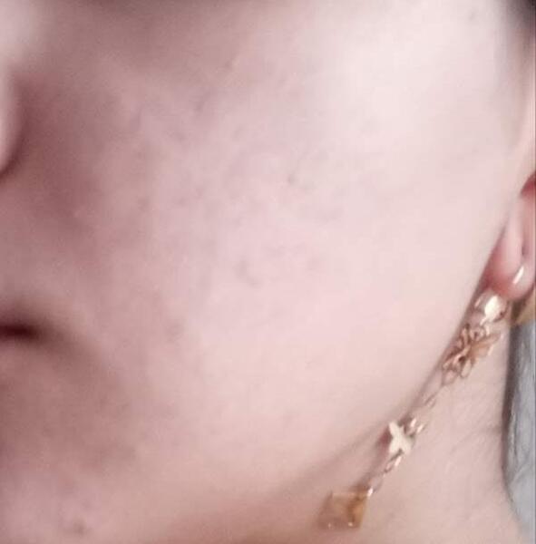 عکس جوش صورتم نی نی سایت