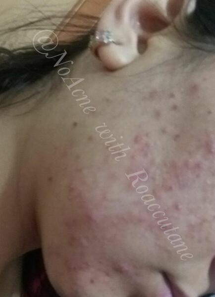 عکس جوش صورتم نی نی سایت