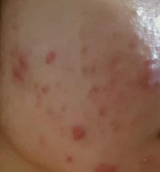عکس جوش صورتم نی نی سایت