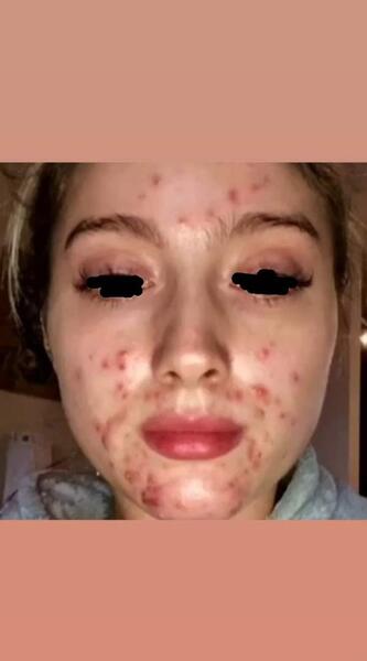 عکس جوش صورتم نی نی سایت