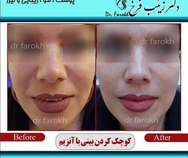 عکس چربی سوزی دماغ