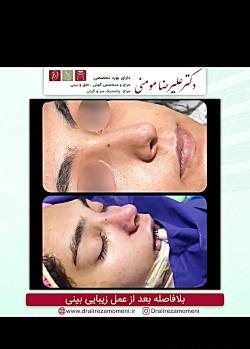 عکس چربی سوزی دماغ