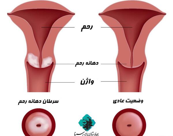 عکس در مورد سرطان