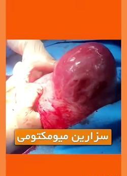 عکس از نزدیک زایمان طبیعی