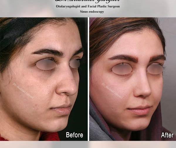 عکس عمل بینی دکتر شهریار یحیوی