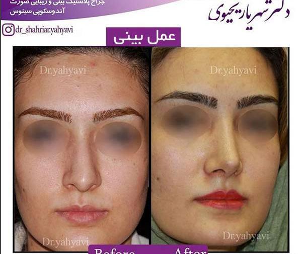 عکس عمل بینی دکتر شهریار یحیوی