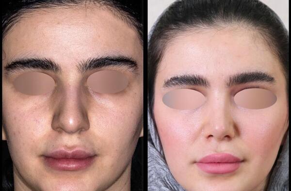 عکس عمل بینی دکتر شهریار یحیوی