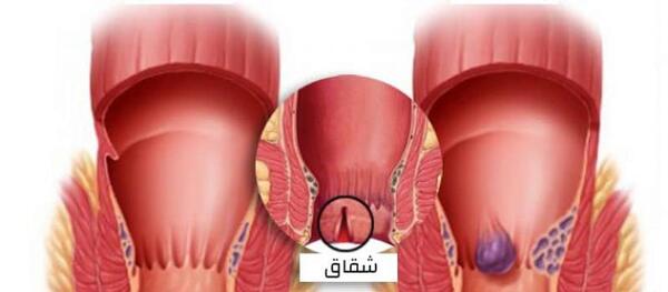 عکس بواسیر
