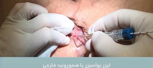 عکس بواسیر