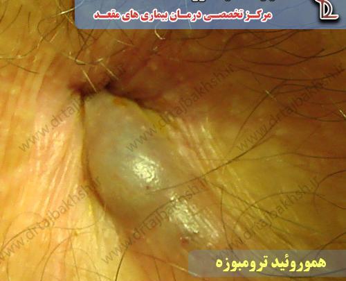 عکس بواسیر