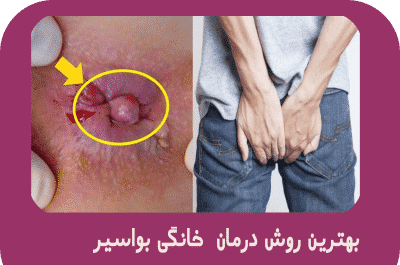 عکس بواسیر