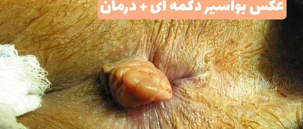 عکس بواسیر
