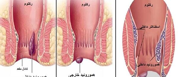 عکس بواسیر