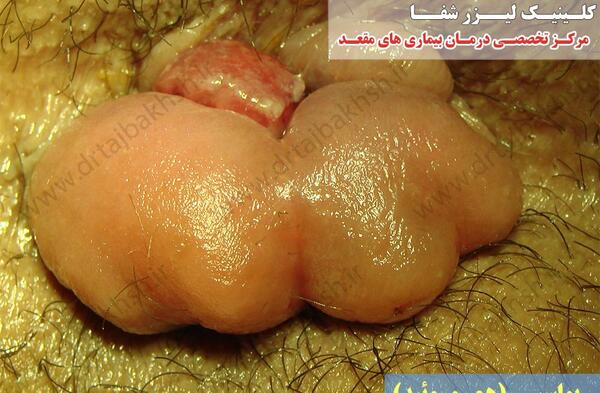 عکس بواسیر